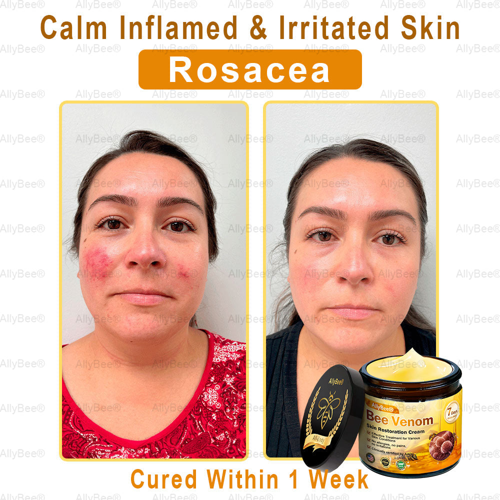 🐝🎁AllyBee® Only 5 Jars Left! 50% OFF – Clear Warts & Moles in 1-4 Weeks! Fast results, gentle on skin. 180-day guarantee. Don’t miss out!