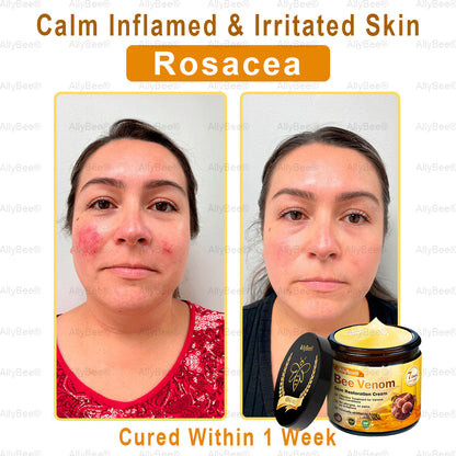 🐝🎁AllyBee® Only 5 Jars Left! 50% OFF – Clear Warts & Moles in 1-4 Weeks! Fast results, gentle on skin. 180-day guarantee. Don’t miss out!